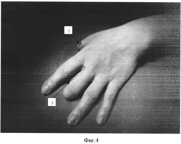 Способ восстановления утраченного первого пальца кисти (патент 2550935)