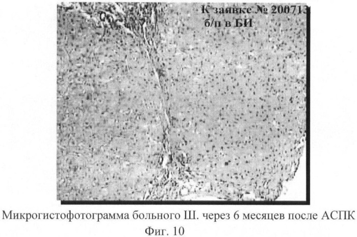 Биотрансплантат, способ лечения хронических заболеваний печени и способ лечения цирроза печени и портальной гипертензии (патент 2368384)