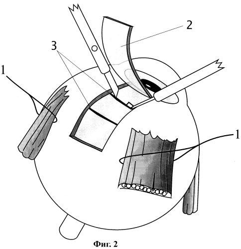 Способ хирургического лечения неоваскулярной формы вторичной глаукомы (патент 2248191)