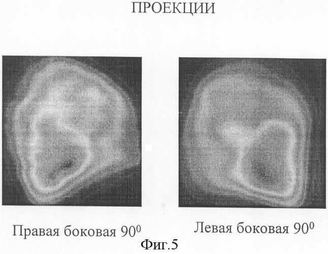 Способ диагностики тромболии мелких ветвей легочной артерии (патент 2303950)