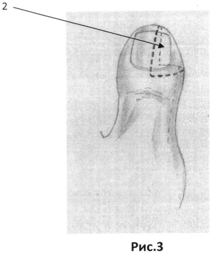 Способ восстановления ногтевого матрикса пальца кисти (патент 2494682)