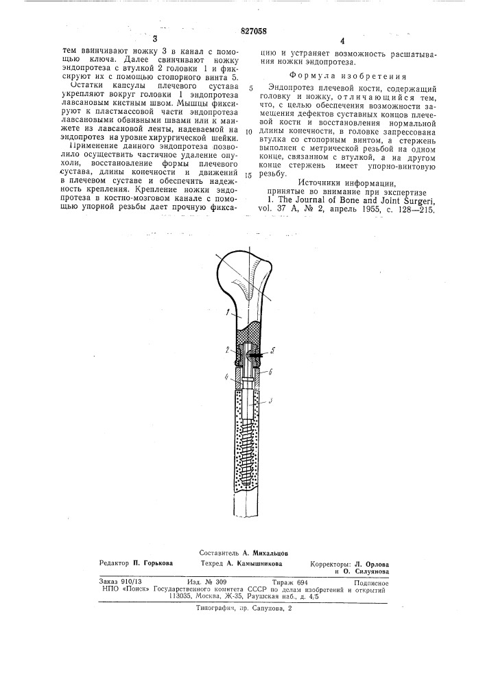Эндопротез плечевой кости (патент 827058)
