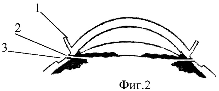 Способ фиксации заднекамерного искусственного хрусталика с с-формой опорных элементов (патент 2268690)