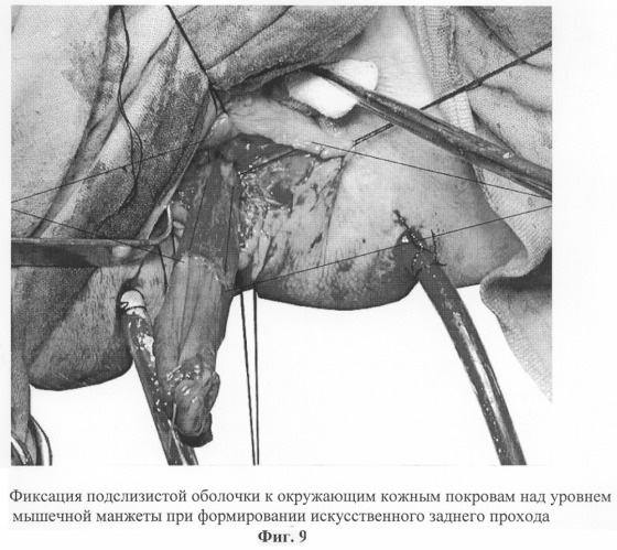 Способ восстановления сосудистого механизма держания при формировании искусственного заднего прохода (патент 2292846)