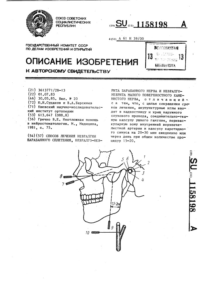 Способ лечения невралгии барабанного сплетения,невралго- неврита барабанного нерва и невралго-неврита малого поверхностного каменистого нерва (патент 1158198)