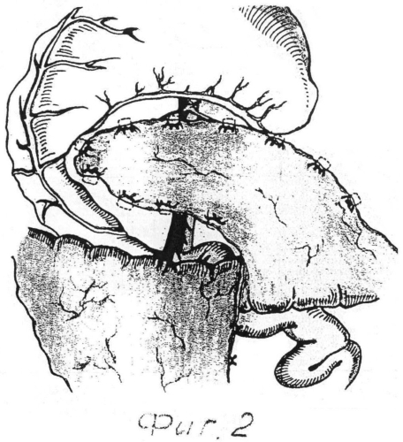 Способ хирургического лечения асептического панкреонекроза (патент 2557417)