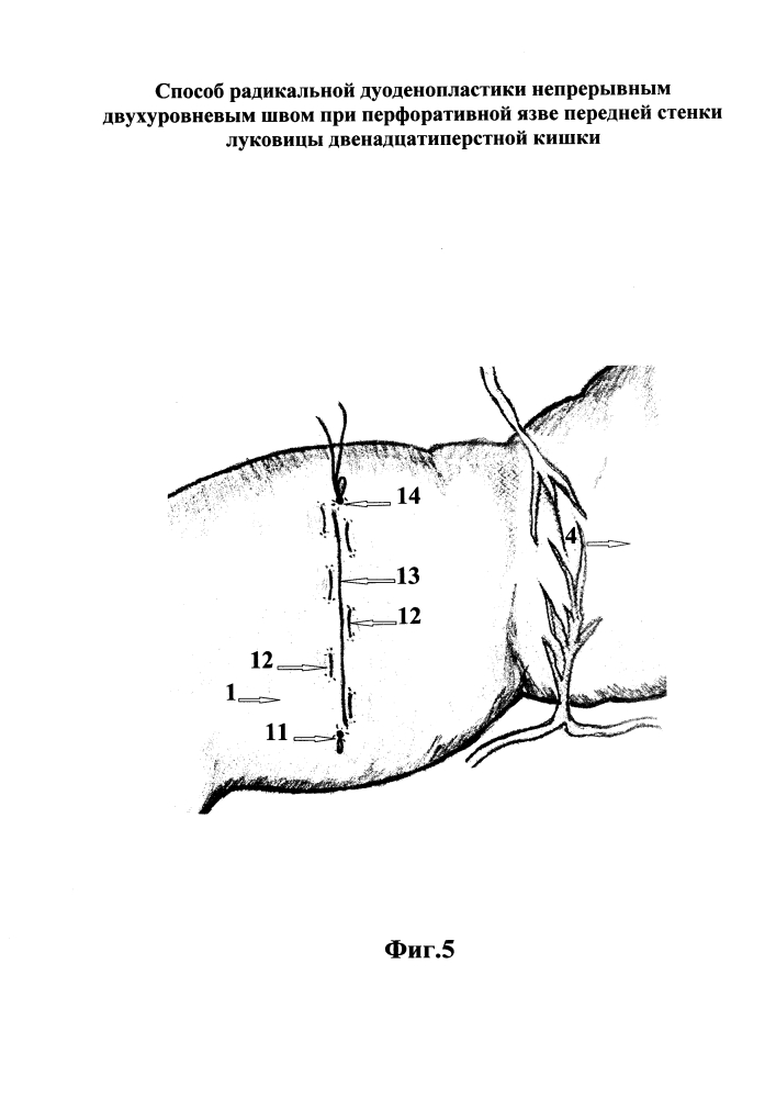 Способ радикальной дуоденопластики непрерывным двухуровневым швом при перфоративной язве передней стенки луковицы двенадцатиперстной кишки (патент 2654272)