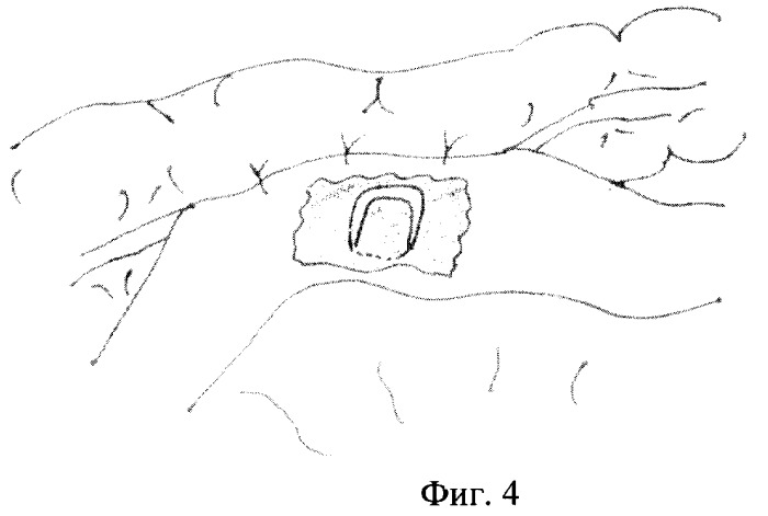 Устройство для создания клапанного компрессионного анастомоза бок в бок (патент 2270622)