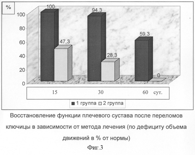 Способ лечения переломов ключицы (патент 2281052)