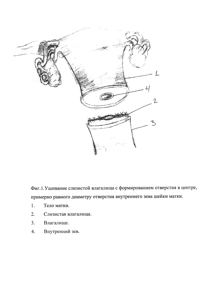 Способ органосохраняющего лечения инвазивного рака шейки матки (патент 2611899)