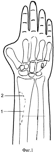 Способ профилактики перелома лучевой кости при пластике "китайским" лоскутом (патент 2506053)