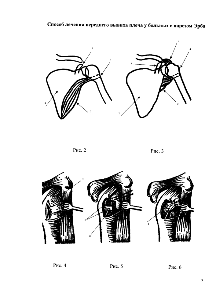 Способ лечения переднего вывиха плеча у больных с парезом эрба (патент 2626197)
