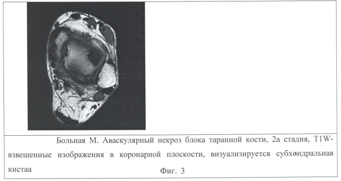 Способ выявления и оценки аваскулярного некроза блока таранной кости с использованием магнитно-резонансной томографии (патент 2403867)