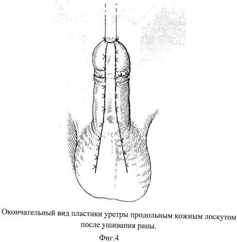 Способ формирования кожного лоскута при пластике уретры по поводу &quot;дистальной&quot; гипоспадии по кравцову ю.а. - i (патент 2454945)