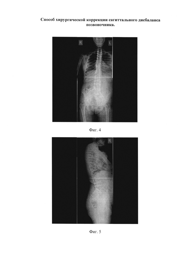 Способ хирургической коррекции сагиттального дисбаланса позвоночника (патент 2629328)