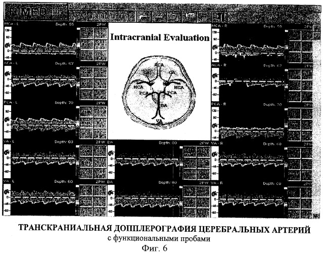 Способ диагностики ранних форм цереброваскулярной недостаточности (патент 2417756)
