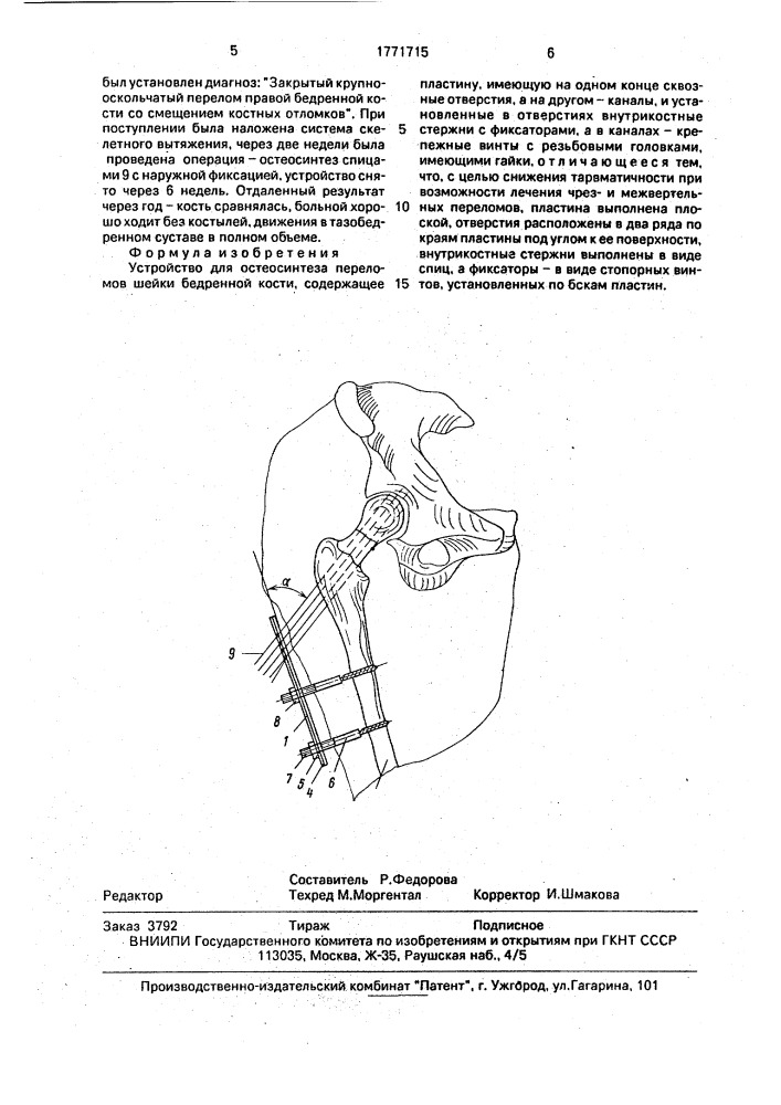 Устройство для остеосинтеза переломов шейки бедренной кости (патент 1771715)