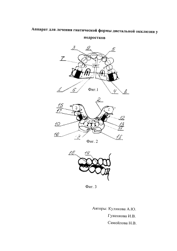Аппарат для лечения гнатической формы дистальной окклюзии у подростков (патент 2591637)