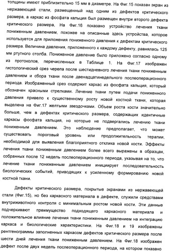 Система и способ продувки устройства пониженного давления во время лечения путем подачи пониженного давления (патент 2404822)