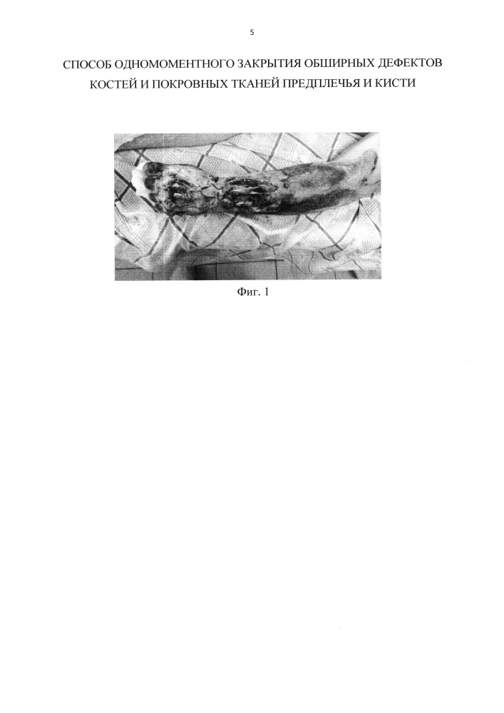 Способ одномоментного закрытия обширных дефектов костей и покровных тканей предплечья и кисти (патент 2645973)