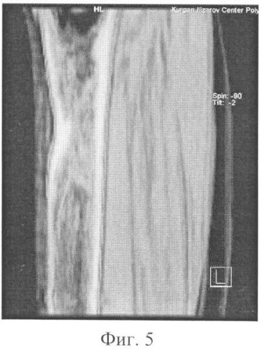 Способ прогнозирования перестройки дистракционного регенерата методом компьютерной томографии (патент 2342904)