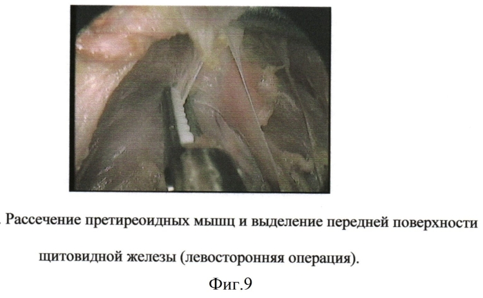 Способ эндовидеохирургического доступа для паратиреоидэктомии (патент 2550733)