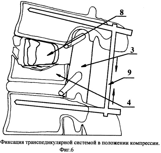 Способ переднего транспедикулярного спондилодеза (патент 2331378)