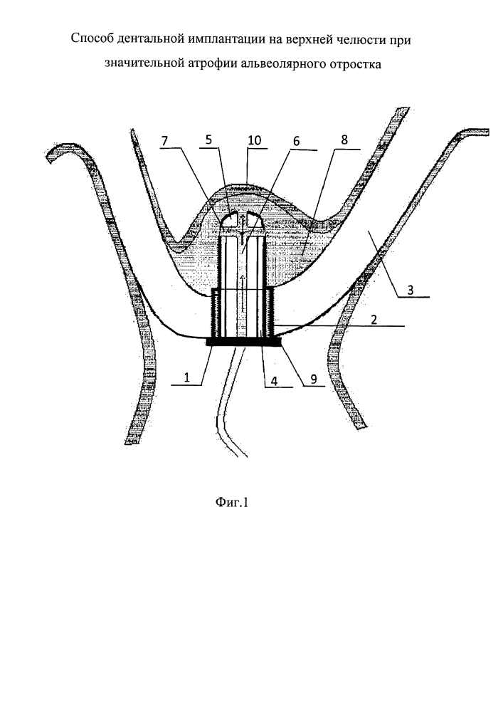 Способ дентальной имплантации на верхней челюсти при значительной атрофии альвеолярного отростка (патент 2600150)