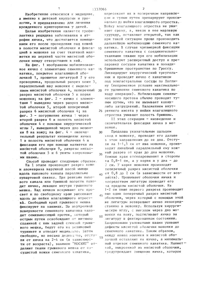 Способ орхиопексии при крипторхизме (патент 1337066)