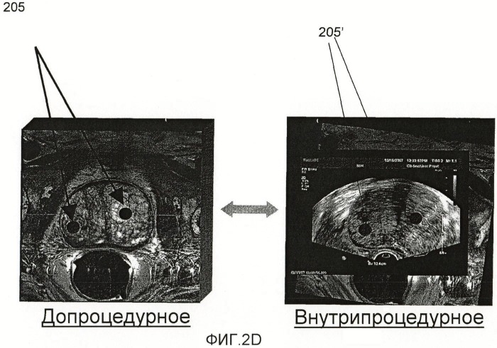 Система и способ для объединения ультразвуковых изображений в реальном времени с ранее полученными медицинскими изображениями (патент 2468436)