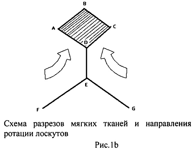 Способ пластического замещения дефектов кожи двумя смежными ротационными лоскутами (патент 2460472)