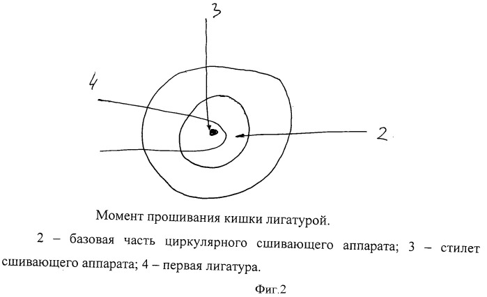 Способ формирования аппаратного колоректального анастомоза (патент 2476160)
