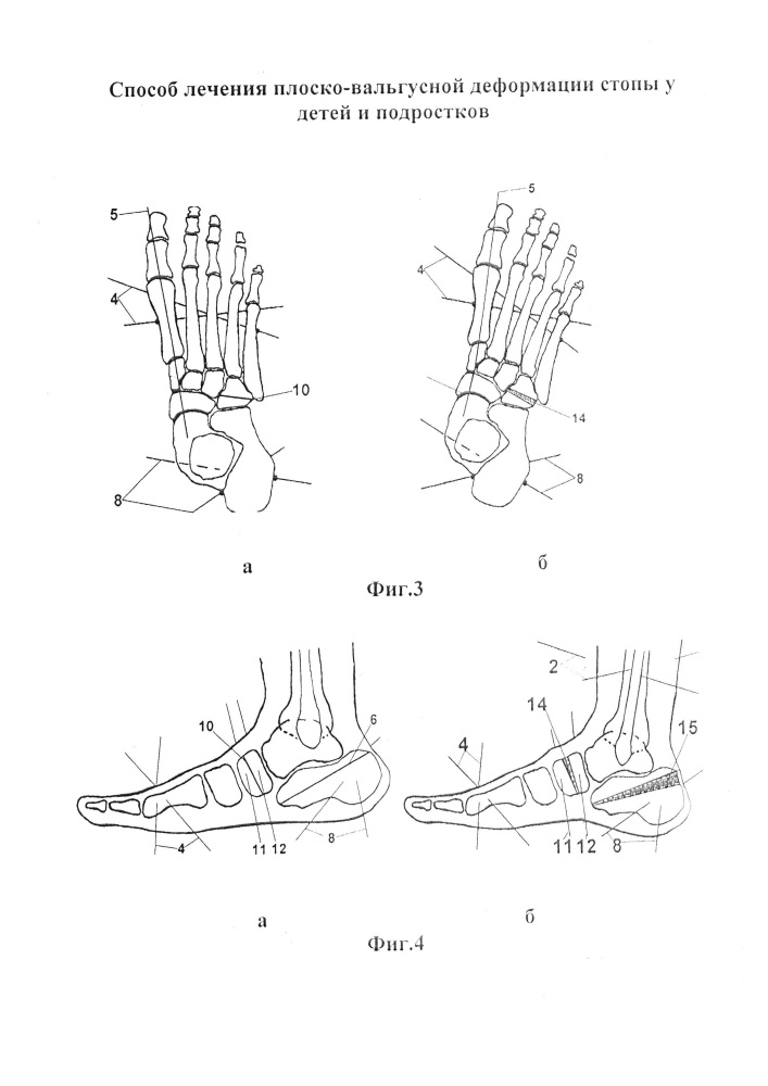 Способ лечения плоско-вальгусной деформации стопы у детей и подростков (патент 2612097)