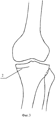 Способ лечения деформирующего артроза коленного сустава (патент 2412667)