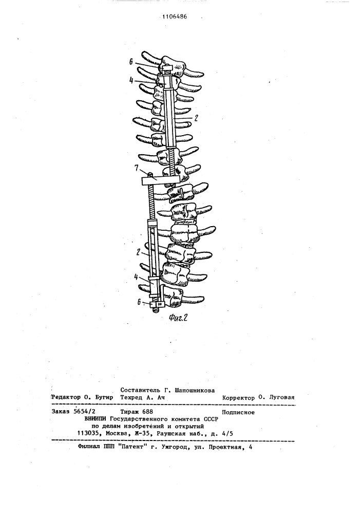 Способ лечения сколиоза и устройство для его осуществления (патент 1106486)