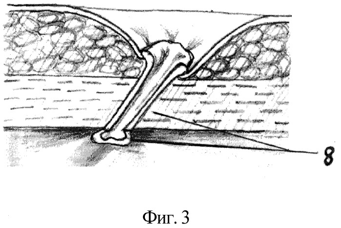 Способ формирования эпицистокутанеостомы (патент 2294161)