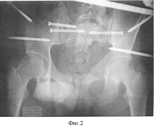 Способ лечения повреждений тазового кольца с неполным и полным разрывом заднего полукольца (патент 2354318)