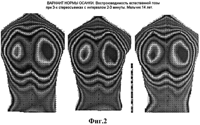 Способ оценки асимметрии формы тела человека по его рельефам (патент 2552884)