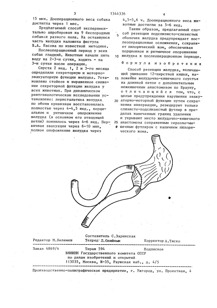 Способ резекции желудка (патент 1344336)