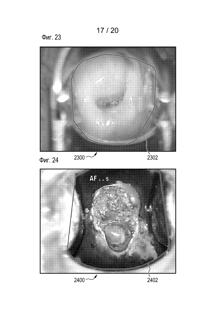 Отбор изображений для оптического исследования шейки матки (патент 2633320)