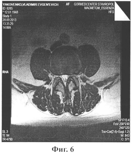Способ лечения грыж поясничных межпозвонковых дисков (патент 2577239)