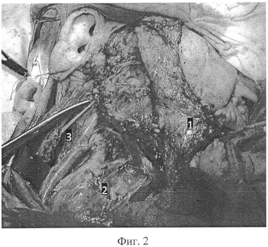 Способ хирургического доступа при шейной лимфодиссекции (патент 2570166)