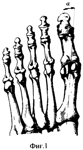 1 плюснефаланговый сустав. Плюснефаланговый сустав 5 пальца руки. Плюснефаланговый сустав 1 пальца стопы. Проекция плюснефалангового сустава. Вальгусная деформация 1 плюснефалангового сустава.
