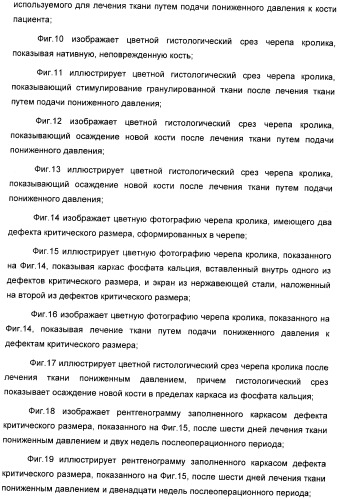 Система и способ продувки устройства пониженного давления во время лечения путем подачи пониженного давления (патент 2404822)