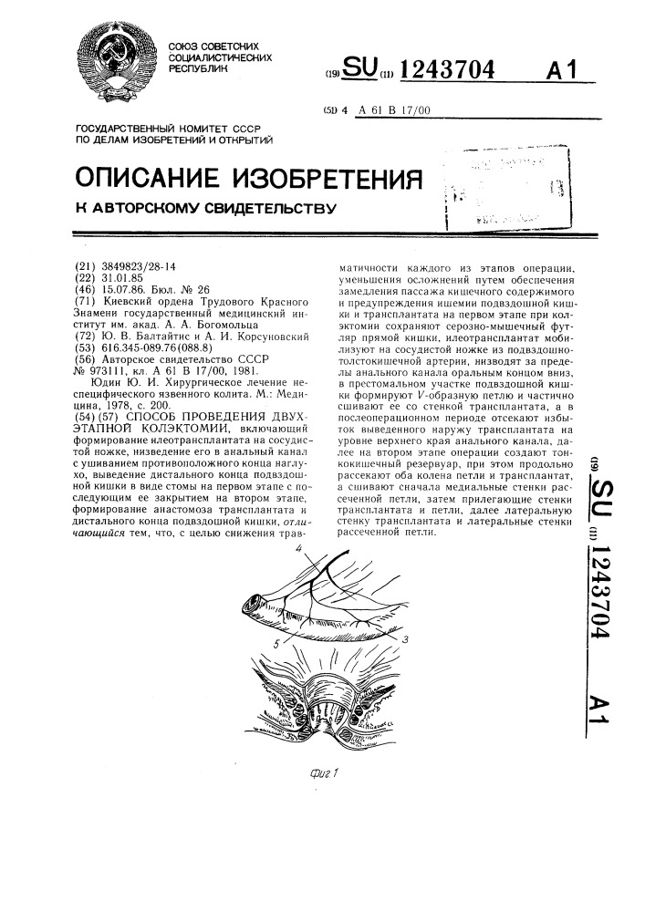 Способ проведения двухэтапной колэктомии (патент 1243704)