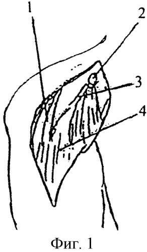 Способ лечения привычного вывиха плеча (патент 2557704)