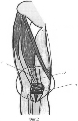 Способ аутопластики переднего отдела коленного сустава после эндопротезирования (патент 2393800)