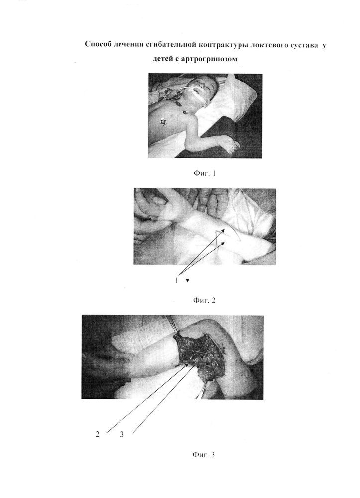 Способ лечения сгибательной контрактуры локтевого сустава у детей с артрогрипозом (патент 2659647)
