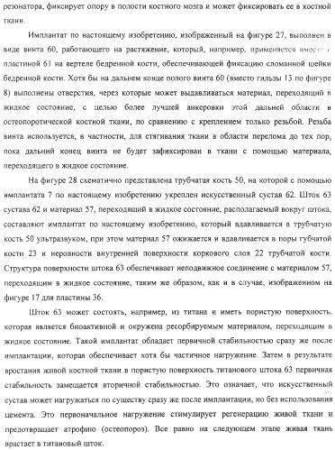 Имплантаты для создания соединений с тканями, в частности со скелетом, а также устройство и способ имплантации (патент 2314768)