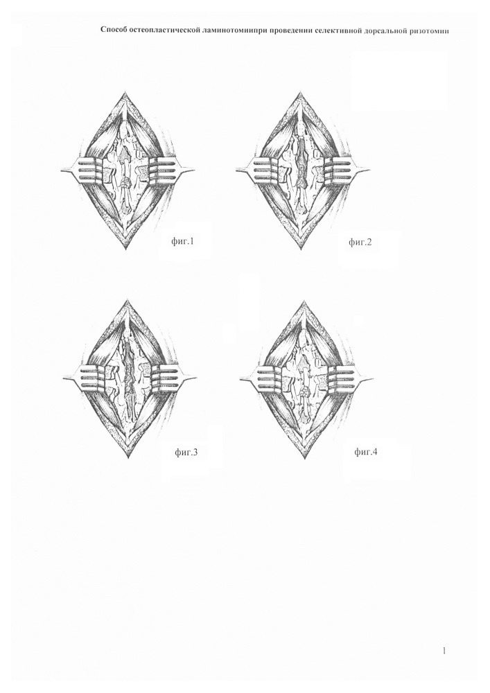Способ остеопластической ламинотомии при проведении селективной дорсальной ризотомии (патент 2611927)